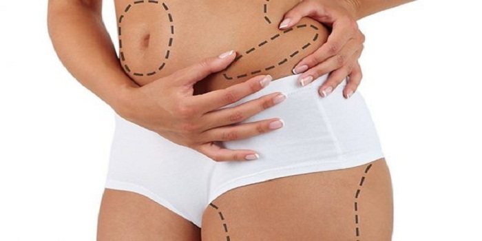Tout savoir sur la cryolipolyse