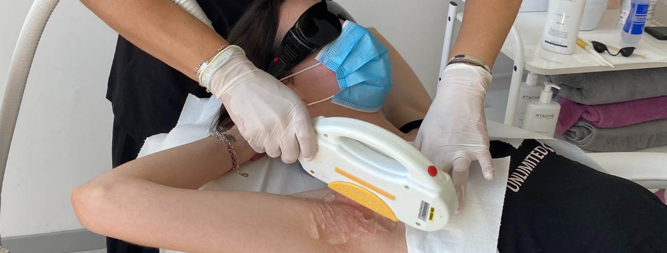 Epilation définitive à Marseille